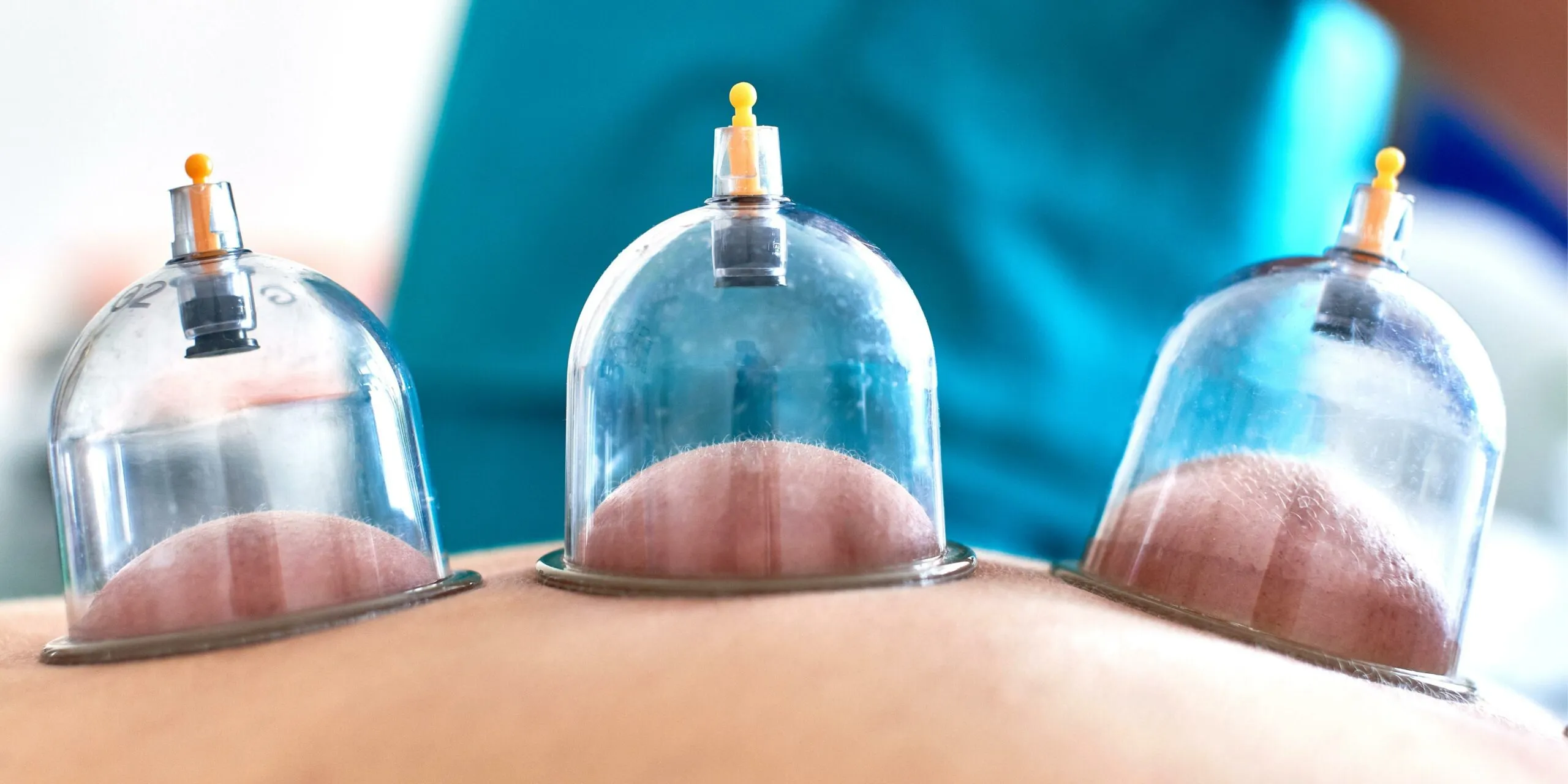 Hijama Cupping Therapy